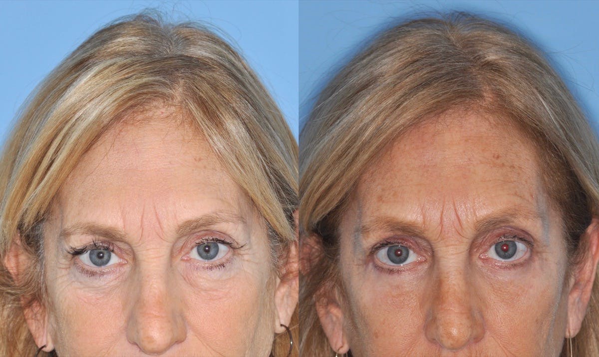 Blepharoplasty Before & After Gallery - Patient 416826 - Image 5