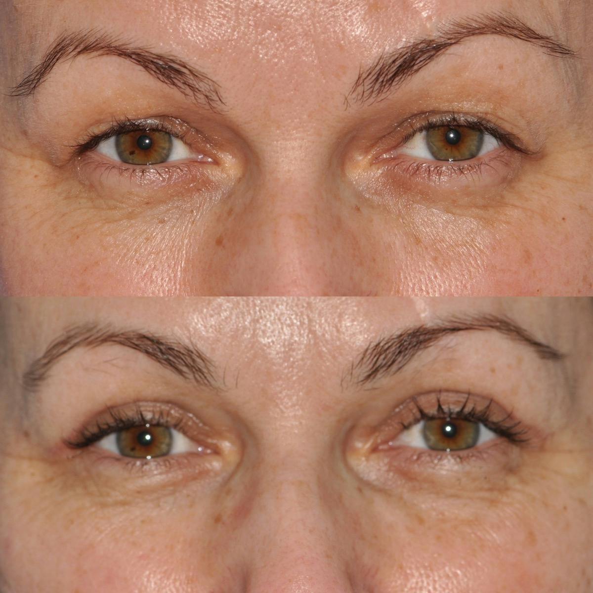 Blepharoplasty Before & After Gallery - Patient 185328 - Image 1