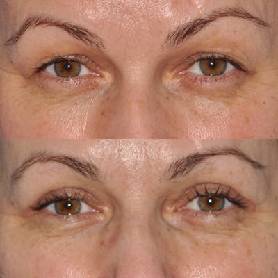 Blepharoplasty Before & After Gallery - Patient 185328 - Image 1