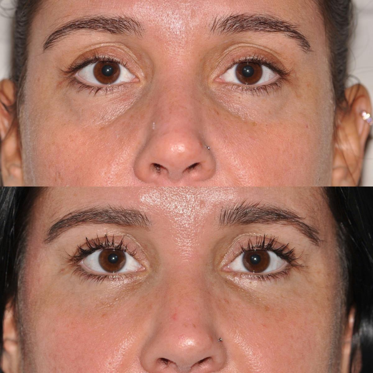 Blepharoplasty Before & After Gallery - Patient 193834 - Image 1