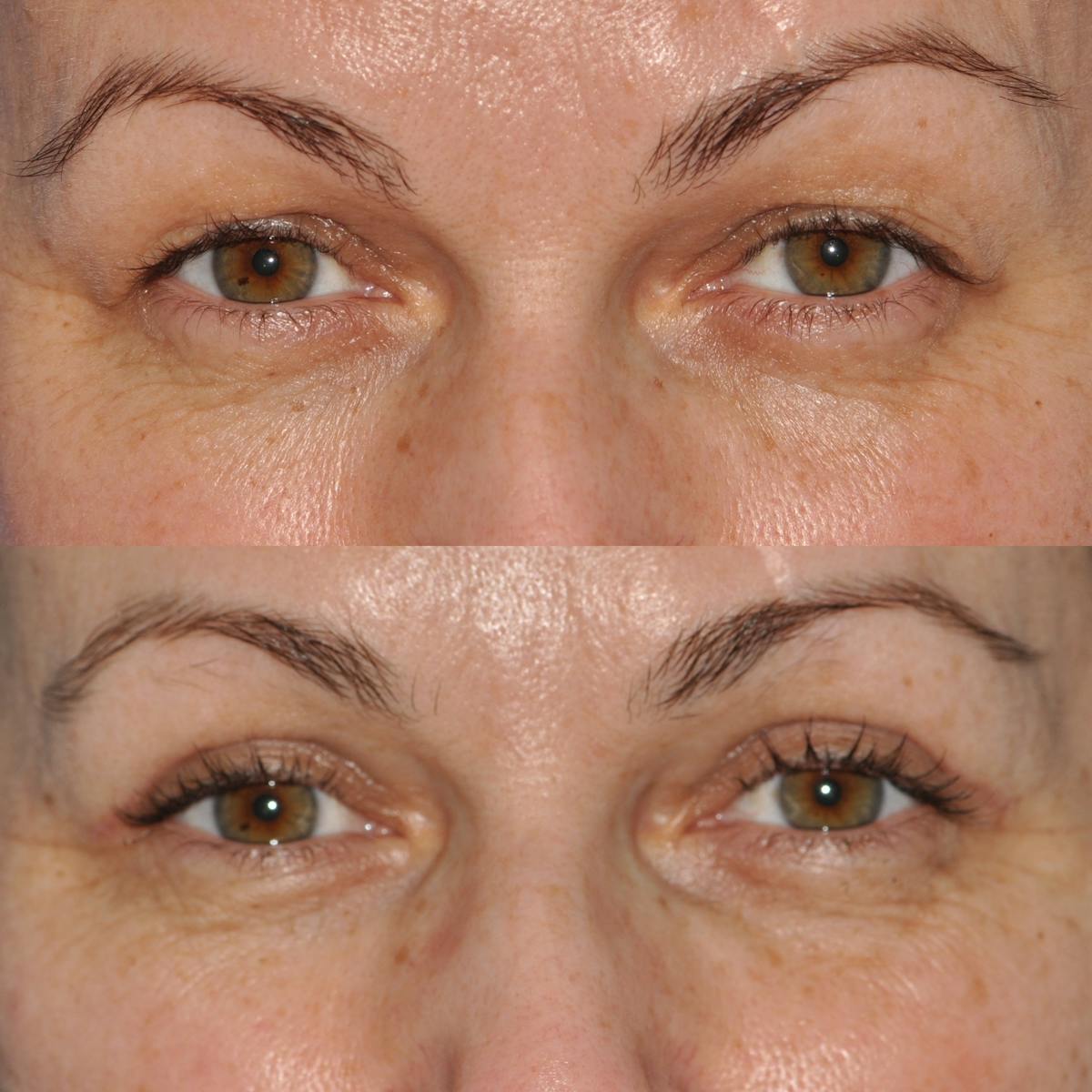 Blepharoplasty Before & After Gallery - Patient 276952 - Image 1
