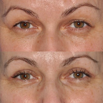 Blepharoplasty Before & After Gallery - Patient 276952 - Image 1