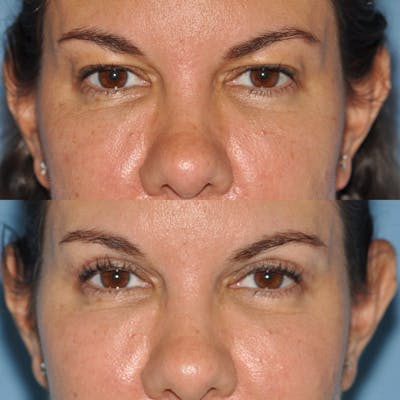 Blepharoplasty Before & After Gallery - Patient 267539 - Image 1