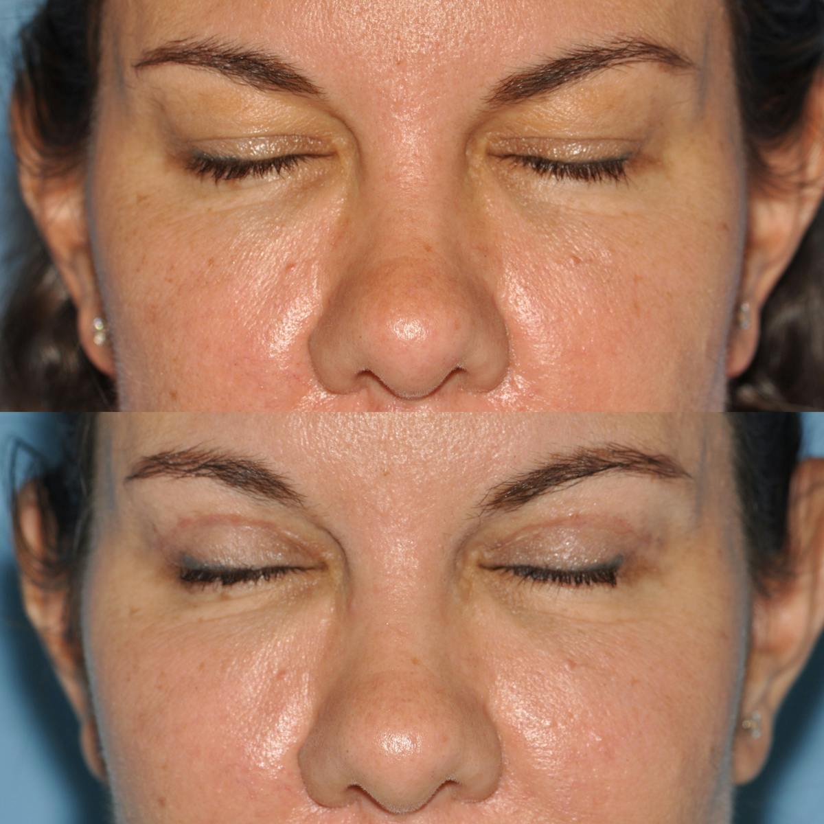 Blepharoplasty Before & After Gallery - Patient 267539 - Image 2