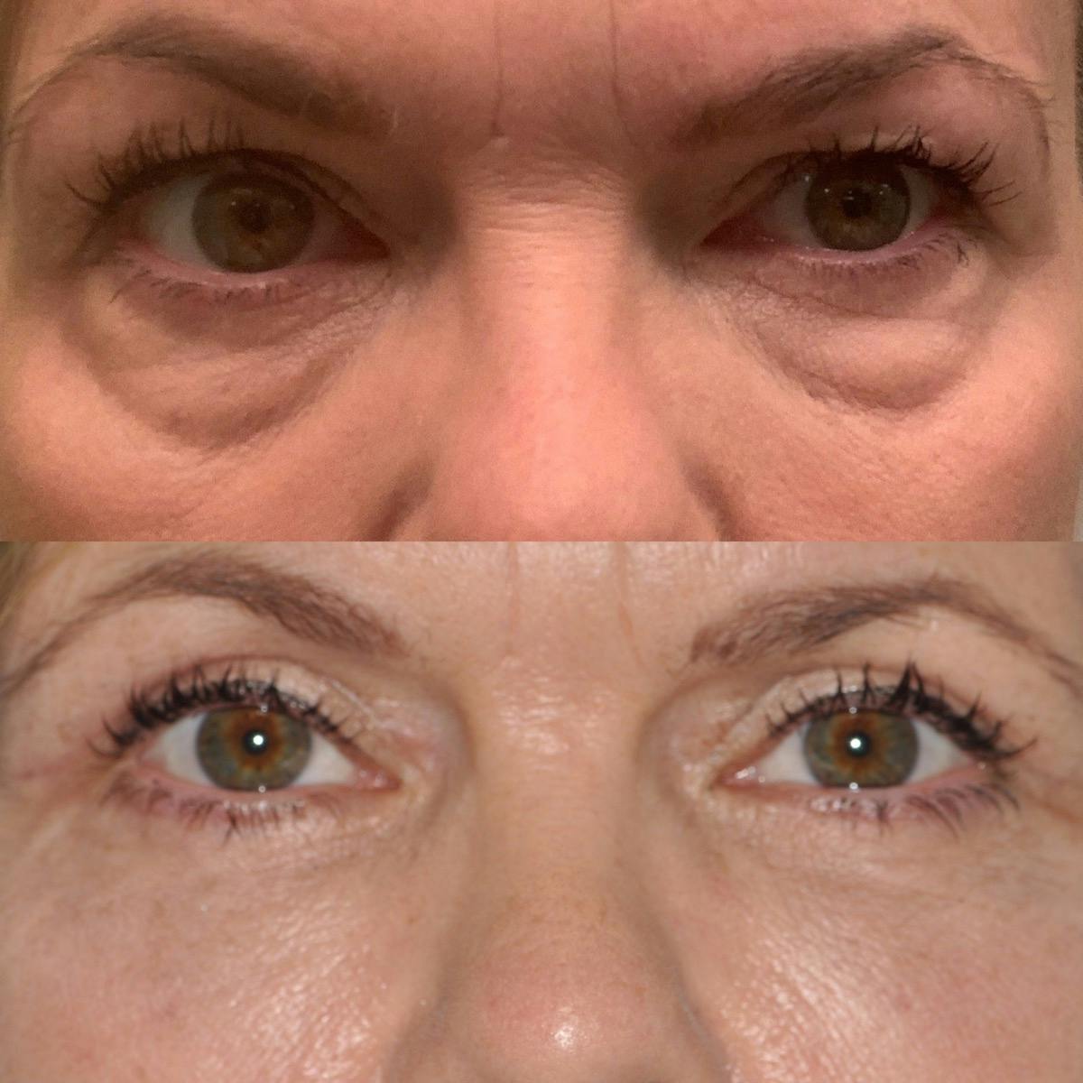 Blepharoplasty Before & After Gallery - Patient 148359 - Image 1