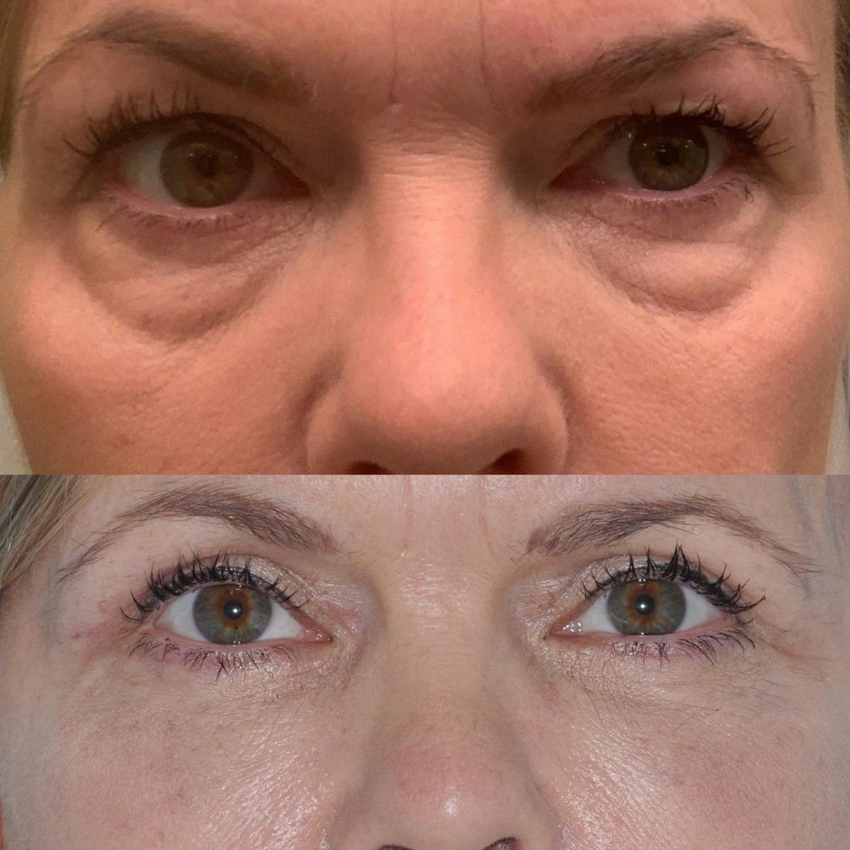 Blepharoplasty Before & After Gallery - Patient 148359 - Image 4
