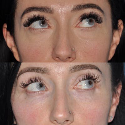 Blepharoplasty Before & After Gallery - Patient 378997 - Image 1