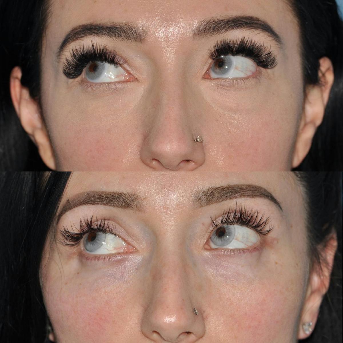 Blepharoplasty Before & After Gallery - Patient 378997 - Image 2