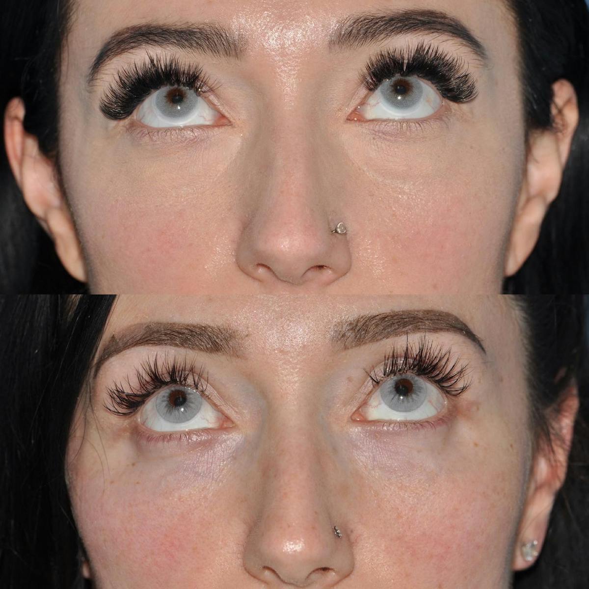 Blepharoplasty Before & After Gallery - Patient 378997 - Image 3
