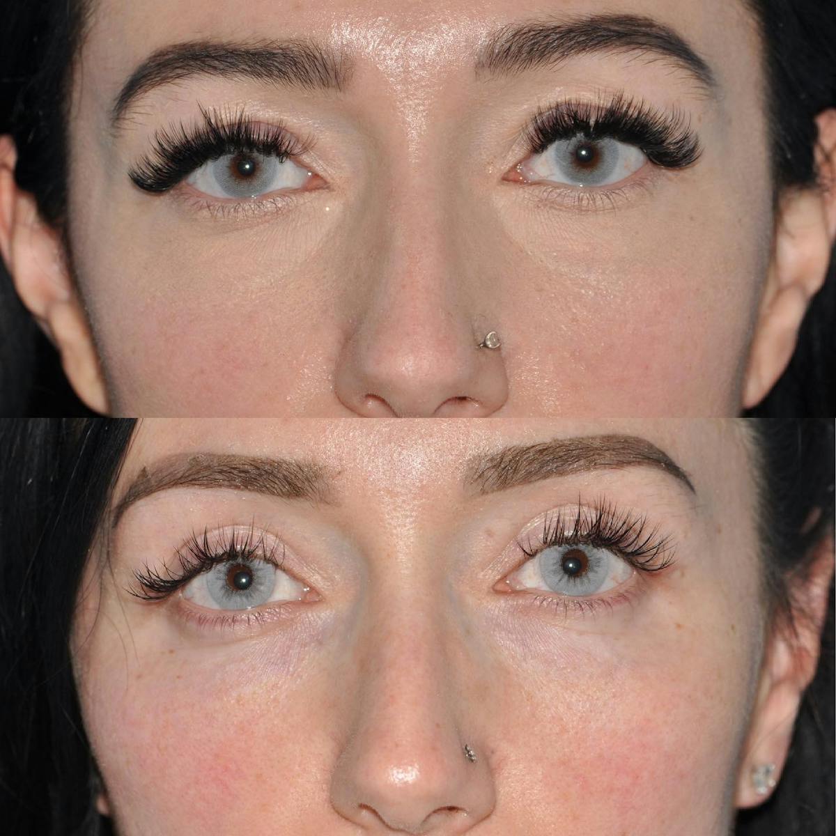 Blepharoplasty Before & After Gallery - Patient 378997 - Image 6