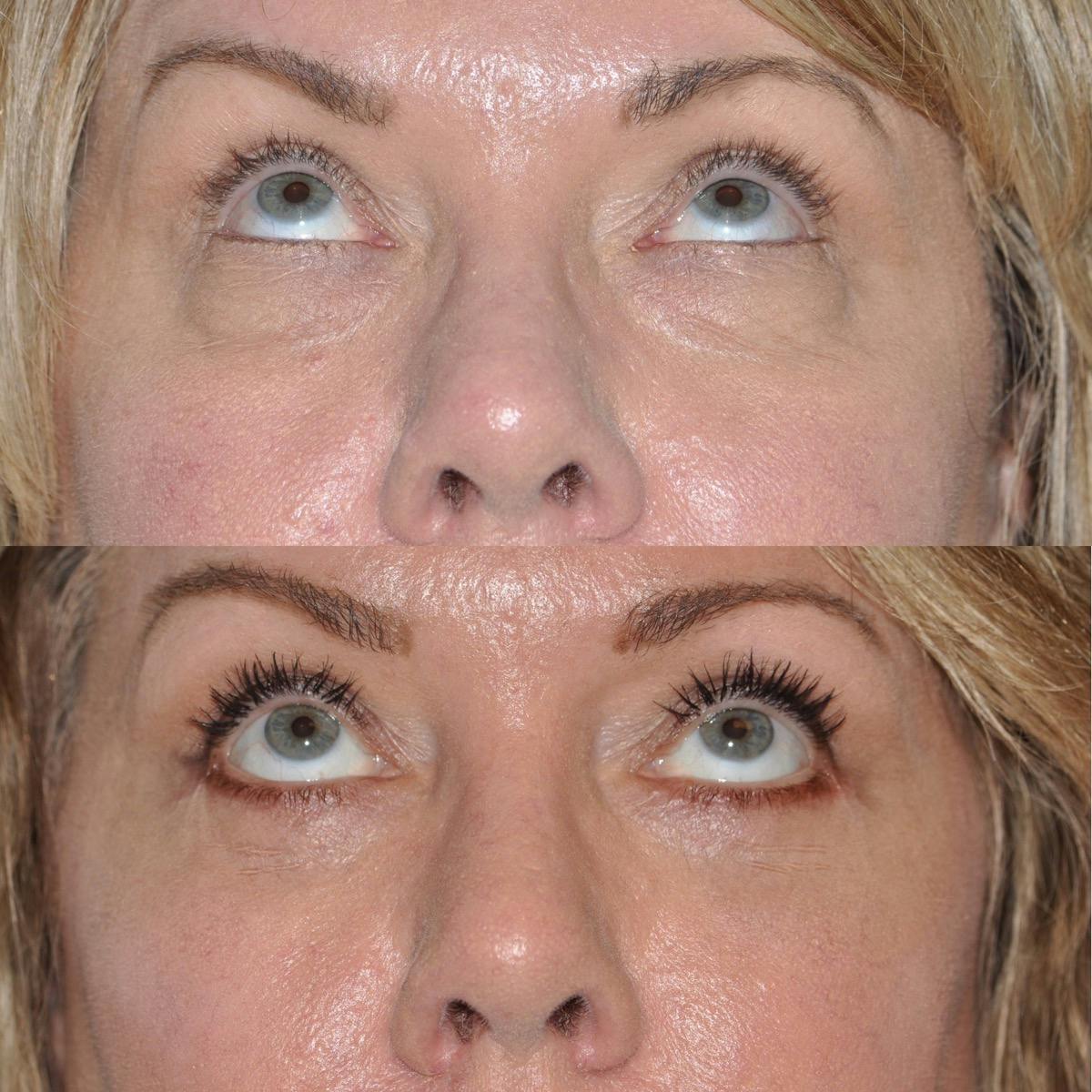 Blepharoplasty Before & After Gallery - Patient 250339 - Image 2