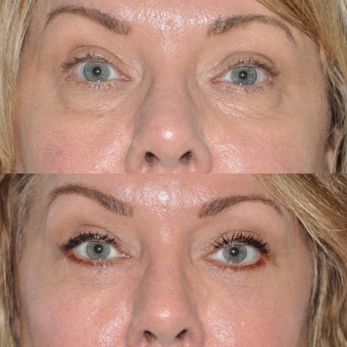 Blepharoplasty Before & After Gallery - Patient 250339 - Image 3
