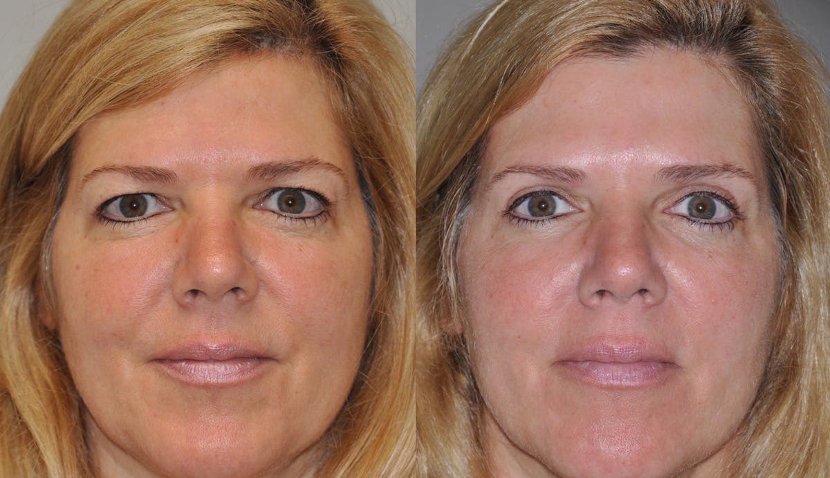Blepharoplasty Before & After Gallery - Patient 398516 - Image 1