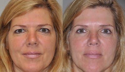 Blepharoplasty Before & After Gallery - Patient 398516 - Image 1