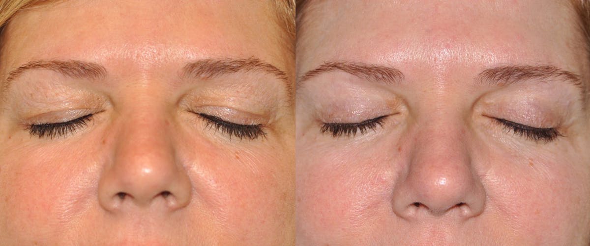 Blepharoplasty Before & After Gallery - Patient 398516 - Image 2