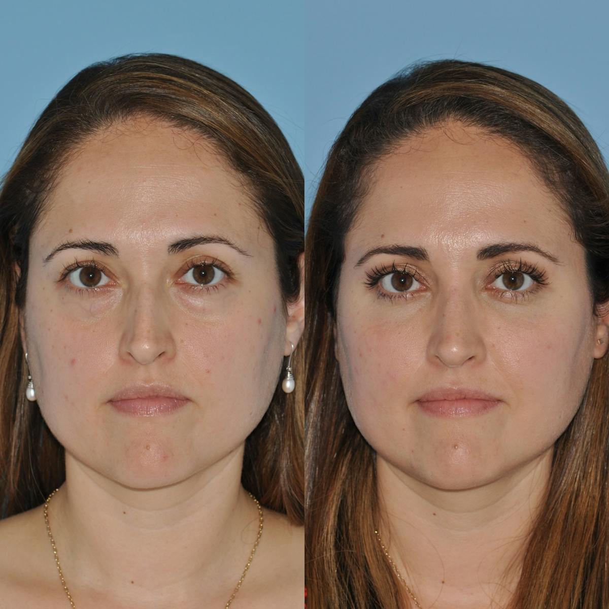 Rhinoplasty Before & After Gallery - Patient 382045 - Image 2