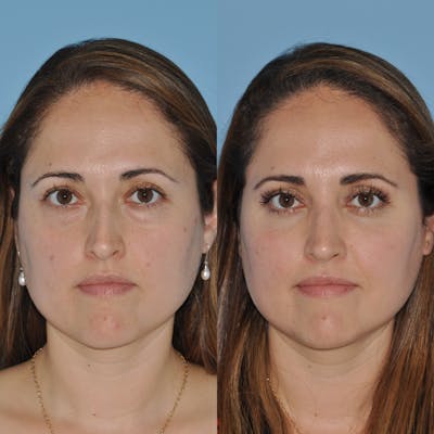 Blepharoplasty Before & After Gallery - Patient 163736 - Image 1