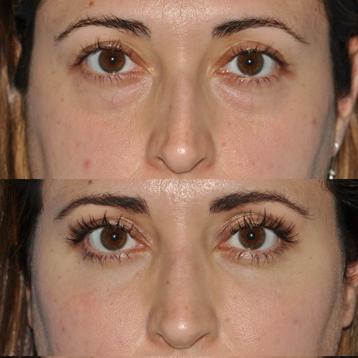 Blepharoplasty Before & After Gallery - Patient 163736 - Image 2