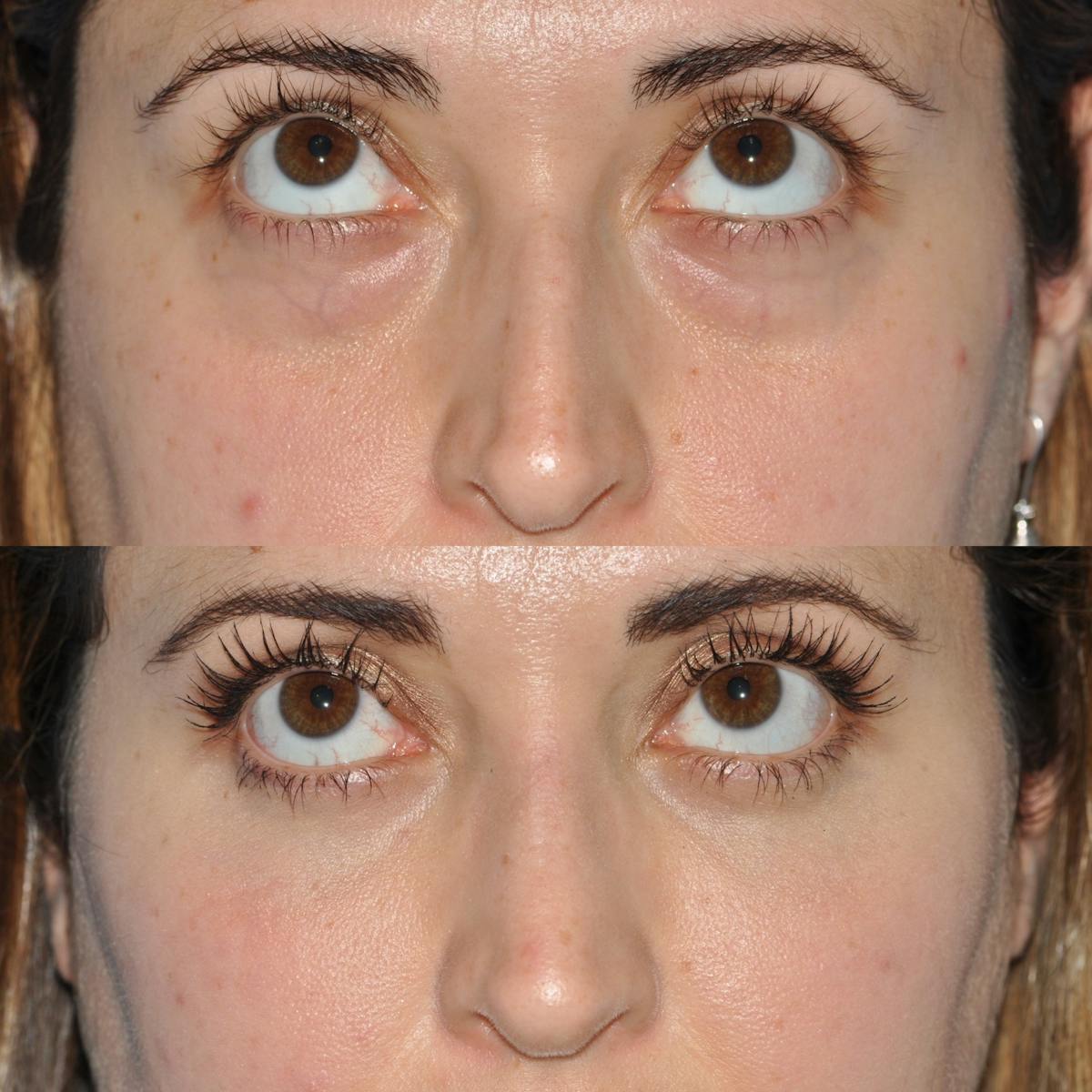 Blepharoplasty Before & After Gallery - Patient 163736 - Image 3