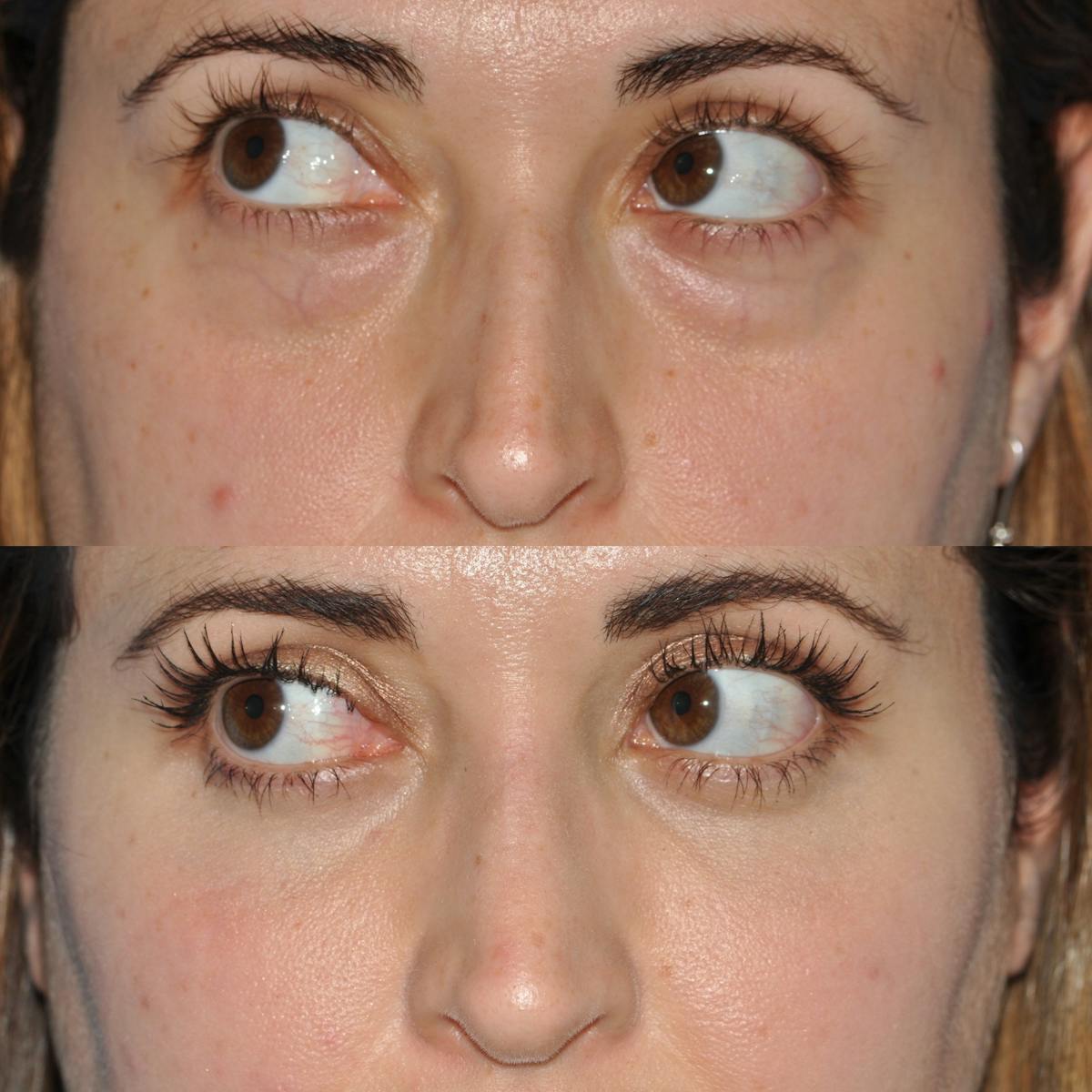 Blepharoplasty Before & After Gallery - Patient 163736 - Image 4