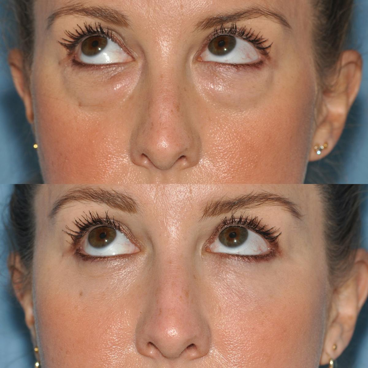 Blepharoplasty Before & After Gallery - Patient 170225 - Image 4