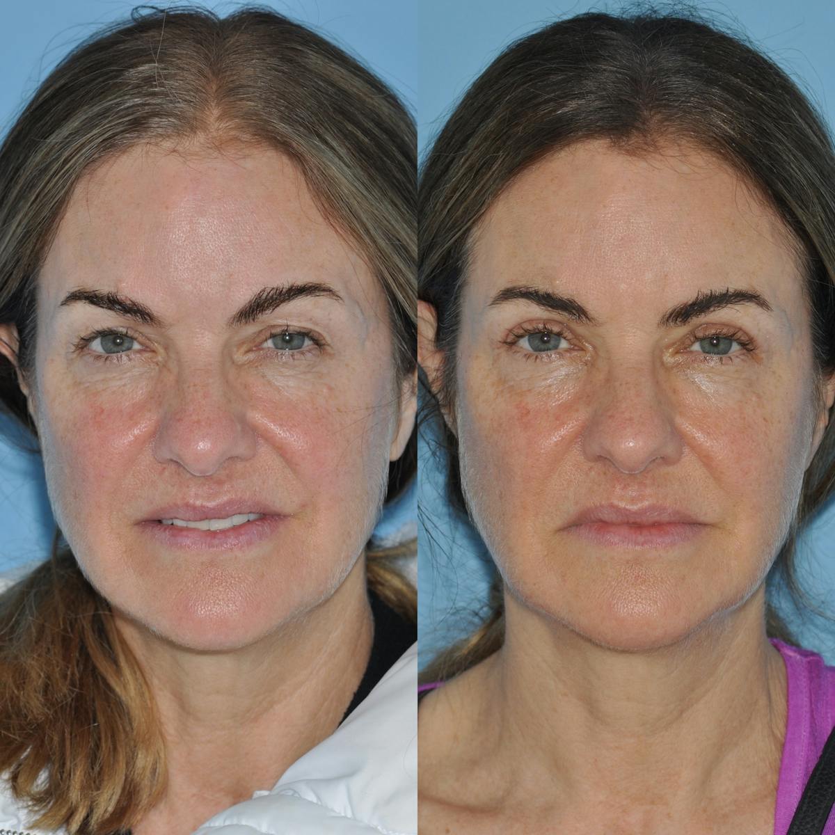 Blepharoplasty Before & After Gallery - Patient 932365 - Image 1