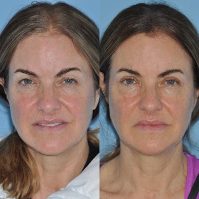 Blepharoplasty Before & After Gallery - Patient 932365 - Image 1