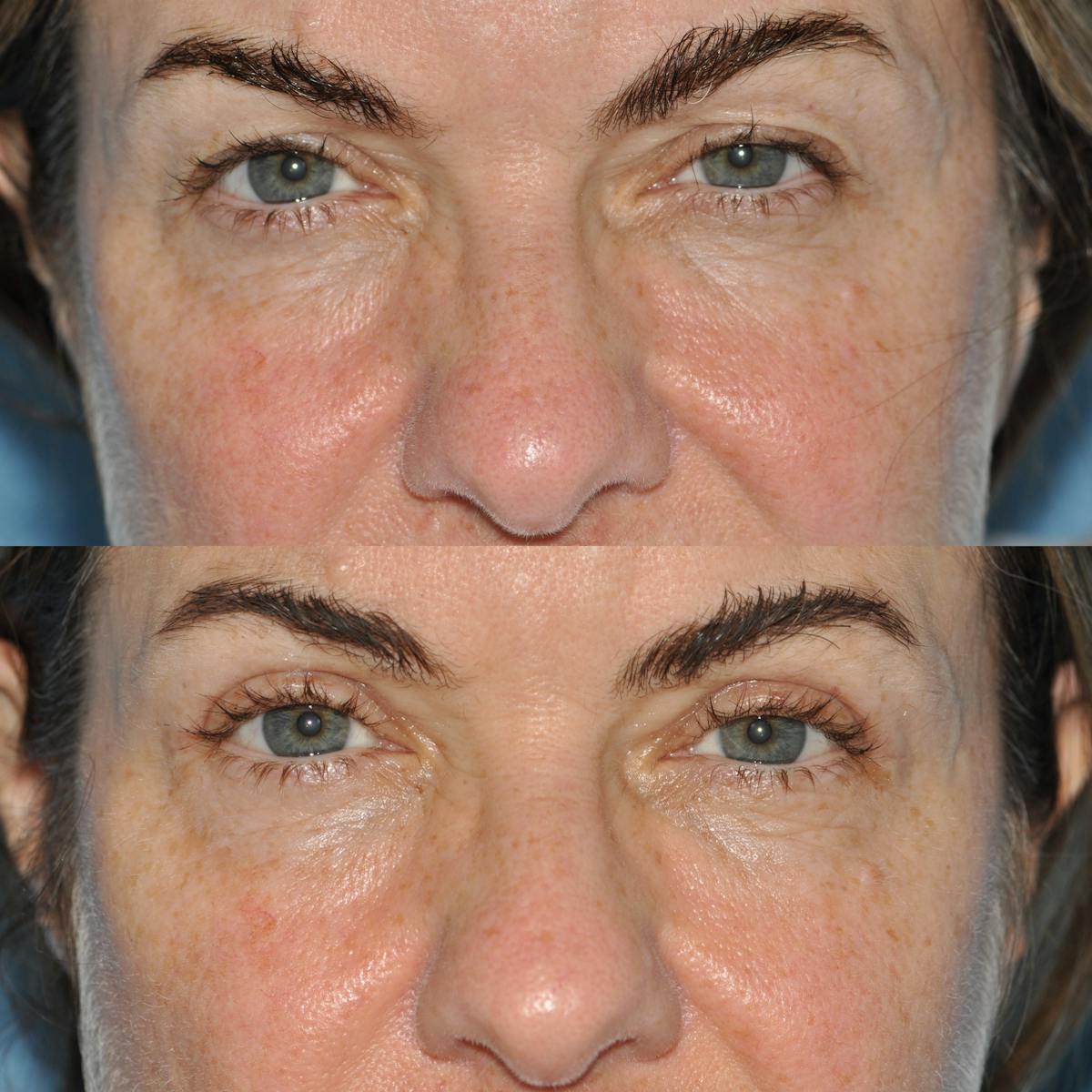 Blepharoplasty Before & After Gallery - Patient 932365 - Image 2