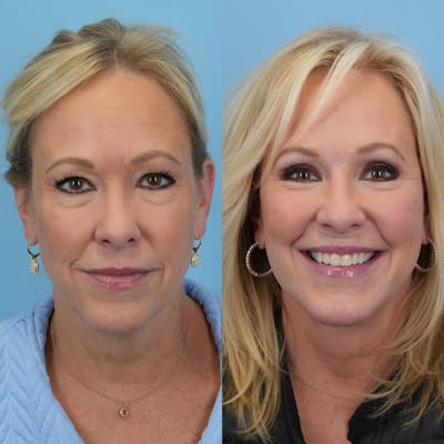 Blepharoplasty Before & After Gallery - Patient 366112 - Image 1