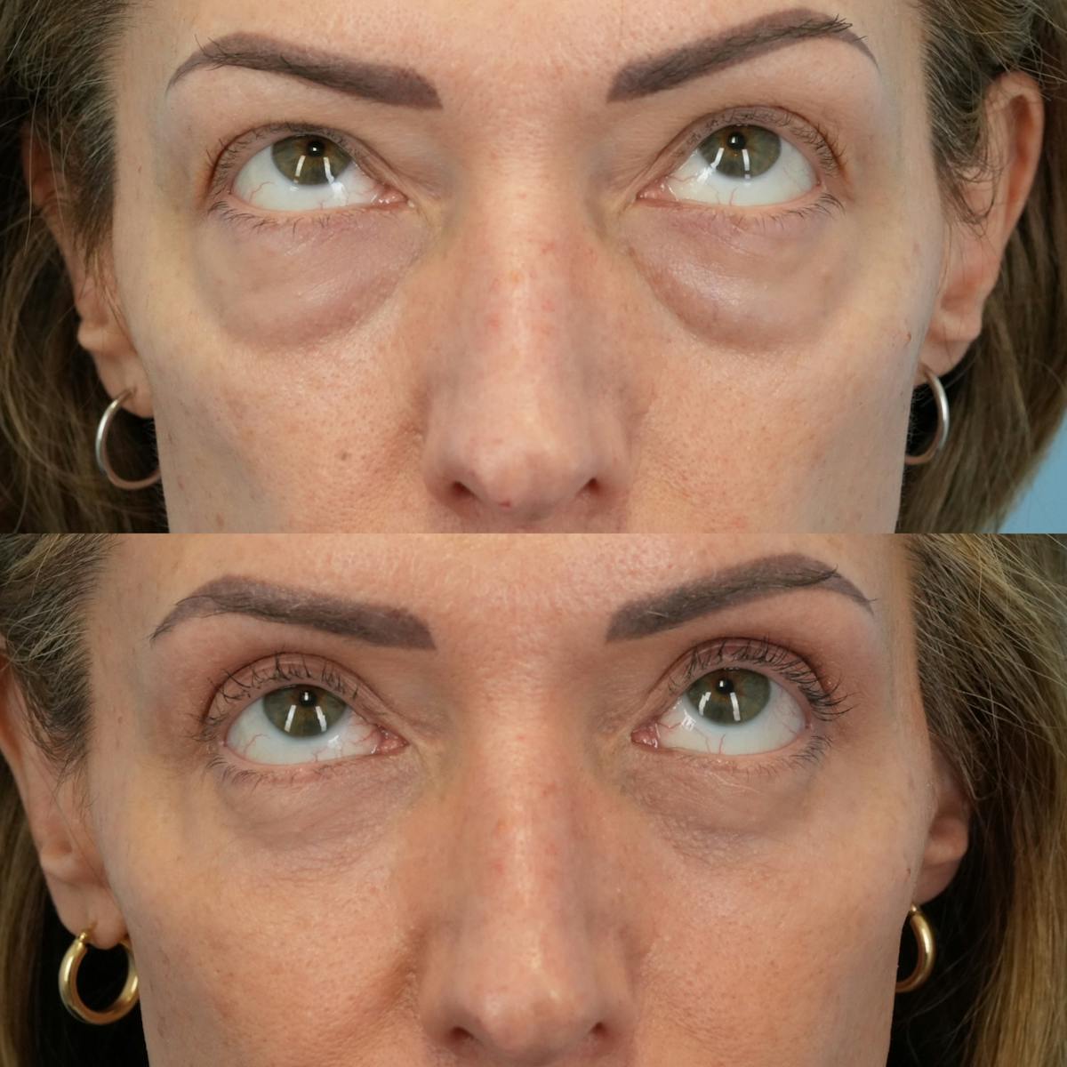 Lower Eyelids Before & After Gallery - Patient 933786 - Image 2
