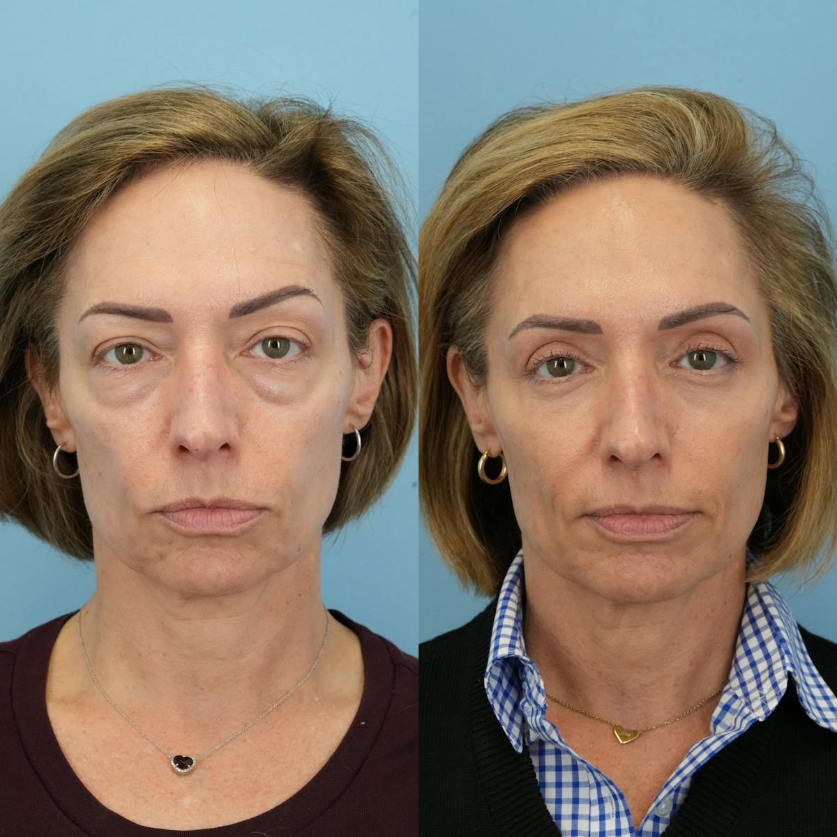 Lower Eyelids Before & After Gallery - Patient 933786 - Image 3