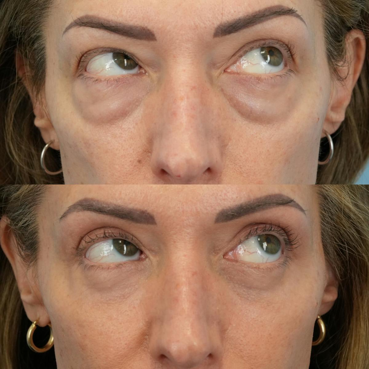 Lower Eyelids Before & After Gallery - Patient 933786 - Image 4