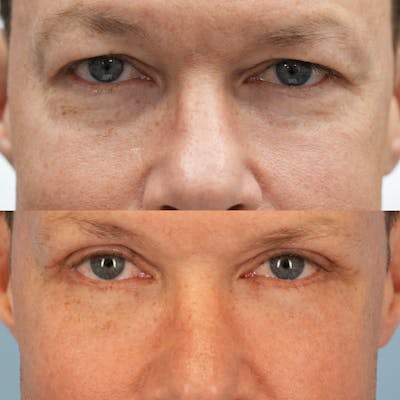 Upper Eyelids Before & After Gallery - Patient 178701 - Image 1