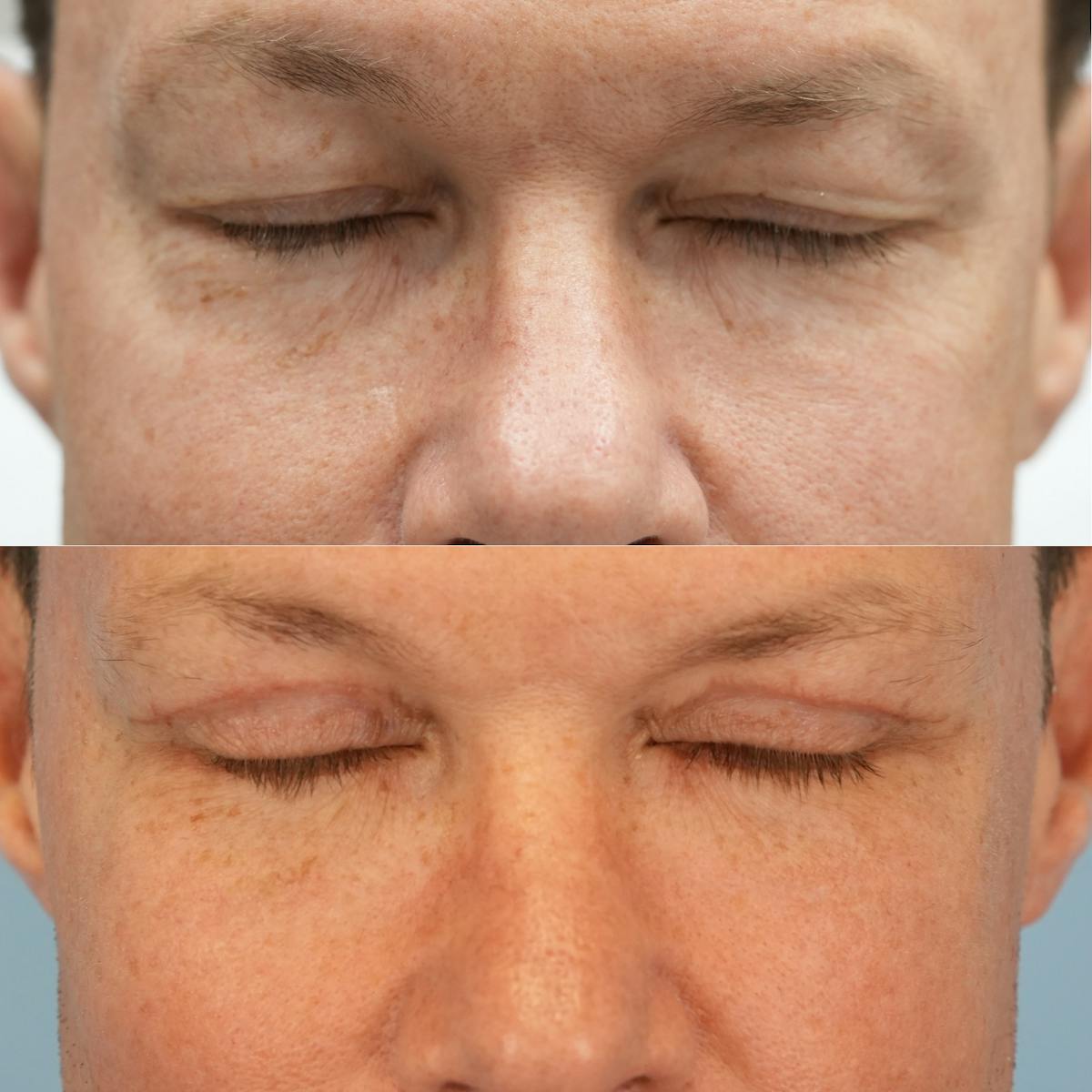 Upper Eyelids Before & After Gallery - Patient 178701 - Image 3