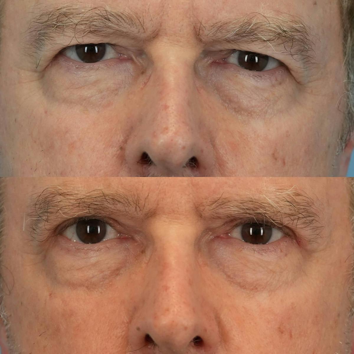 Upper Eyelids Before & After Gallery - Patient 118870 - Image 1