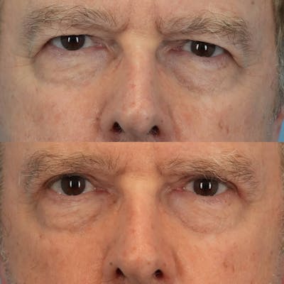 Upper Eyelids Before & After Gallery - Patient 118870 - Image 1