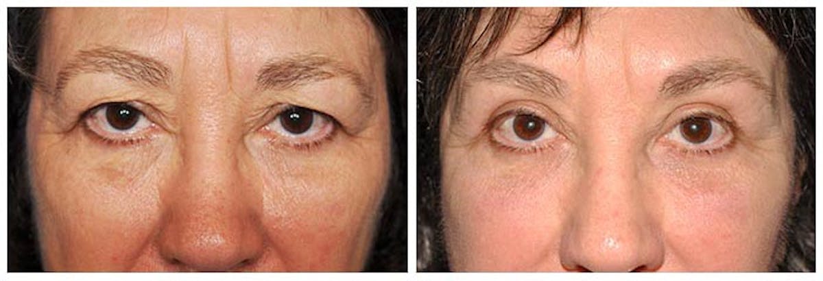 Upper Eyelids Before & After Gallery - Patient 115197 - Image 1
