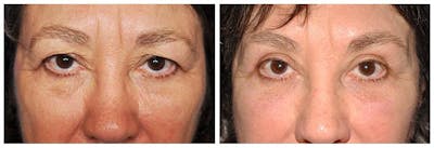 Upper Eyelids Before & After Gallery - Patient 115197 - Image 1