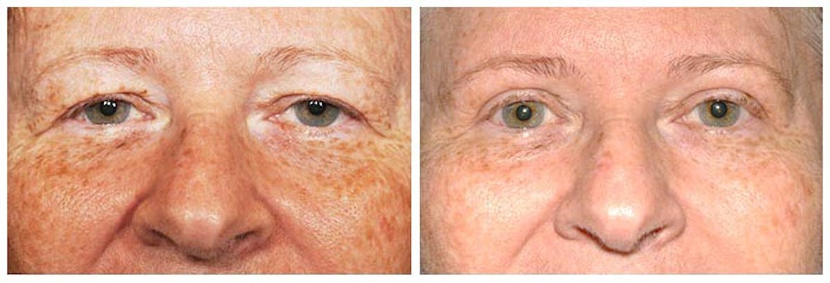 Upper Eyelids Before & After Gallery - Patient 224473 - Image 1