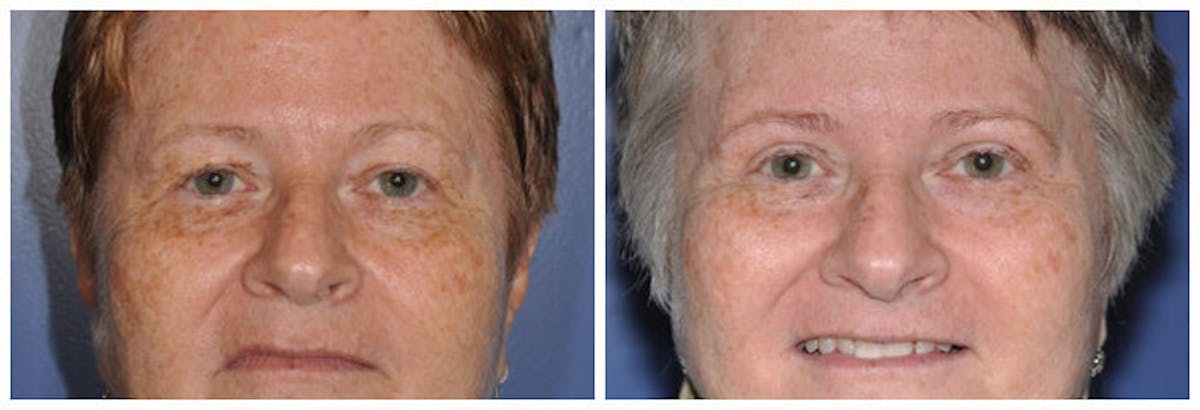 Upper Eyelids Before & After Gallery - Patient 224473 - Image 2