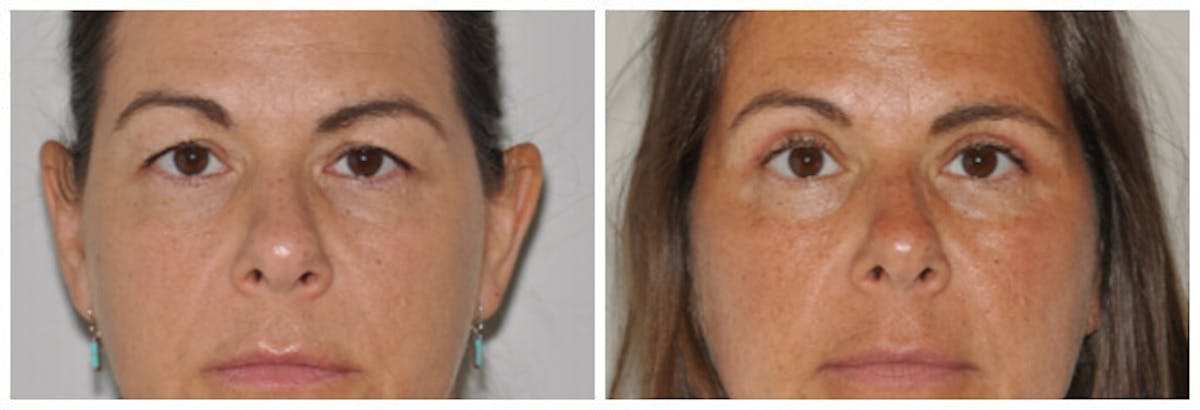 Upper Eyelids Before & After Gallery - Patient 470698 - Image 1