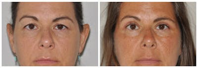 Upper Eyelids Before & After Gallery - Patient 470698 - Image 1