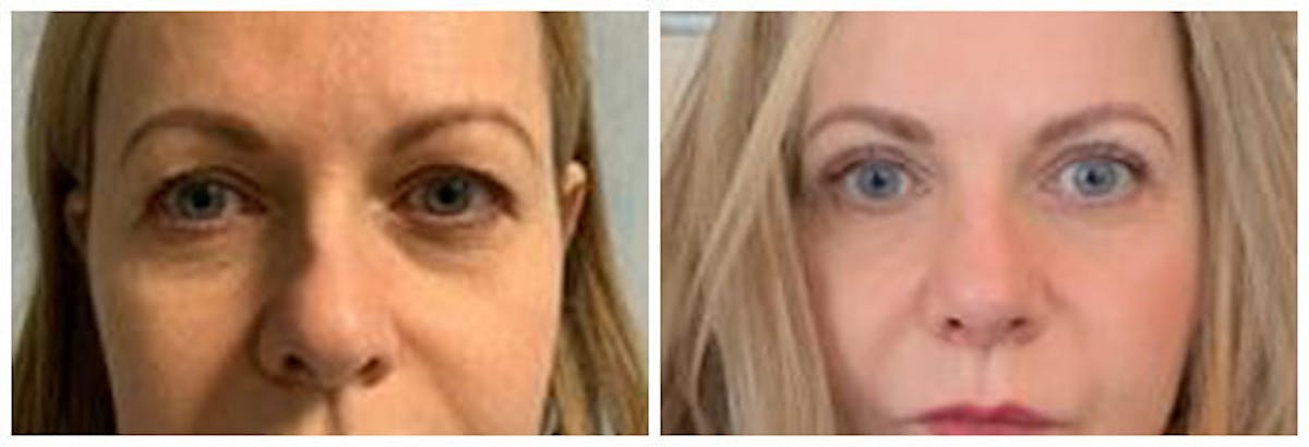 Upper Eyelids Before & After Gallery - Patient 579187 - Image 1