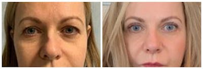 Upper Eyelids Before & After Gallery - Patient 579187 - Image 1