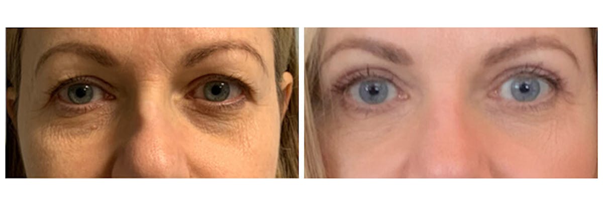 Upper Eyelids Before & After Gallery - Patient 579187 - Image 2
