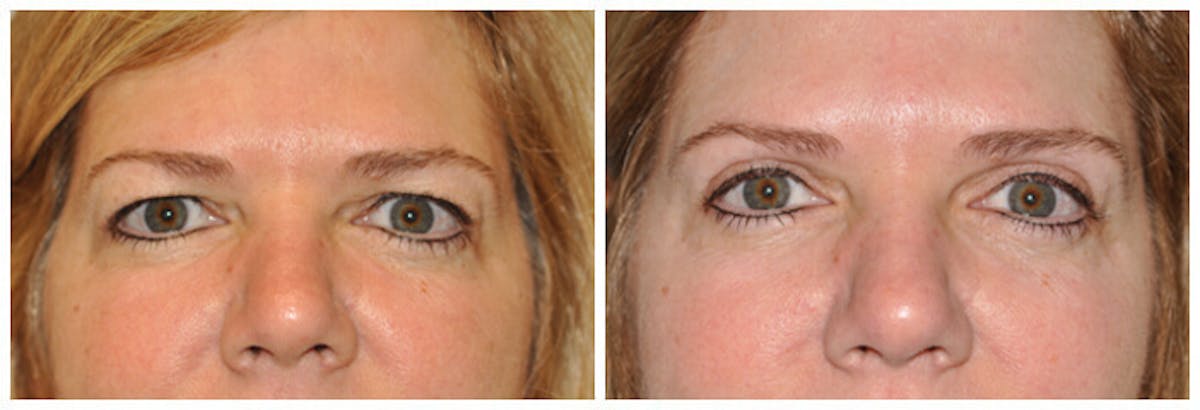 Upper Eyelids Before & After Gallery - Patient 600259 - Image 1