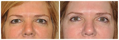 Upper Eyelids Before & After Gallery - Patient 600259 - Image 1