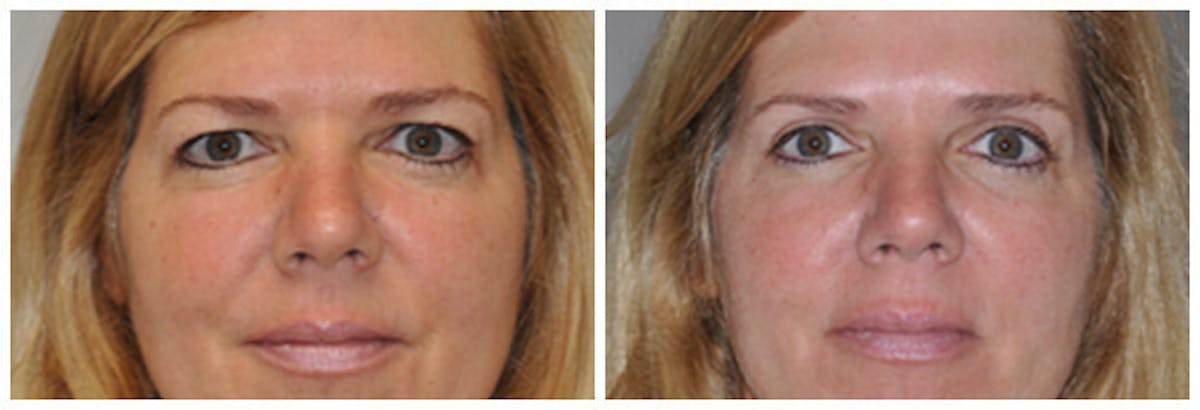 Upper Eyelids Before & After Gallery - Patient 600259 - Image 2