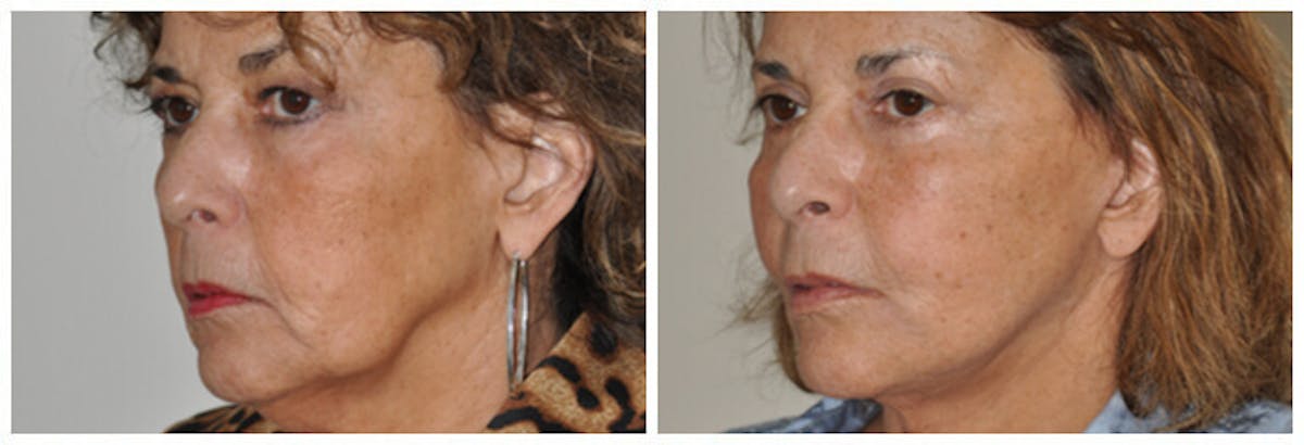 Upper Eyelids Before & After Gallery - Patient 100565 - Image 1