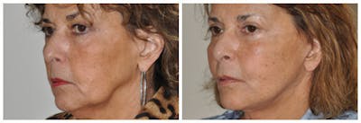 Upper Eyelids Before & After Gallery - Patient 100565 - Image 1